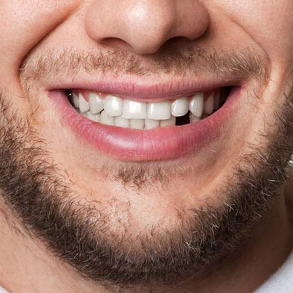 Man with missing tooth