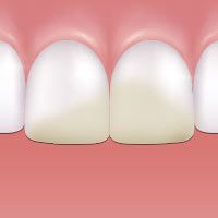 Stained teeth