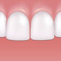 Gapped teeth